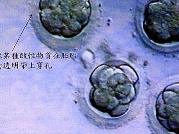 微创子宫肌瘤休息多久可恢复